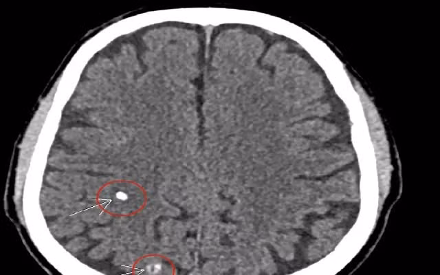 Đi khám bệnh tuyến giáp, người đàn ông 66 tuổi bất ngờ phát hiện sán não ảnh 1