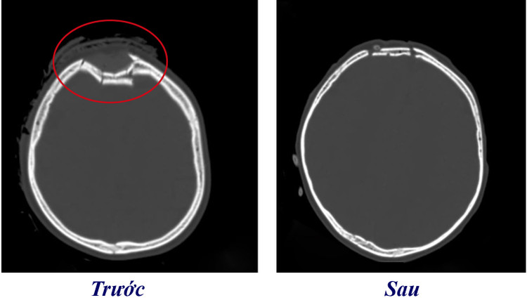 Phim chụp sọ não bé trước và sau khi phẫu thuật. Ảnh BVCC