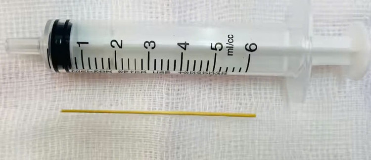 Chiếc tăm che được lấy ra. Ảnh TTYT huyện Phù Ninh