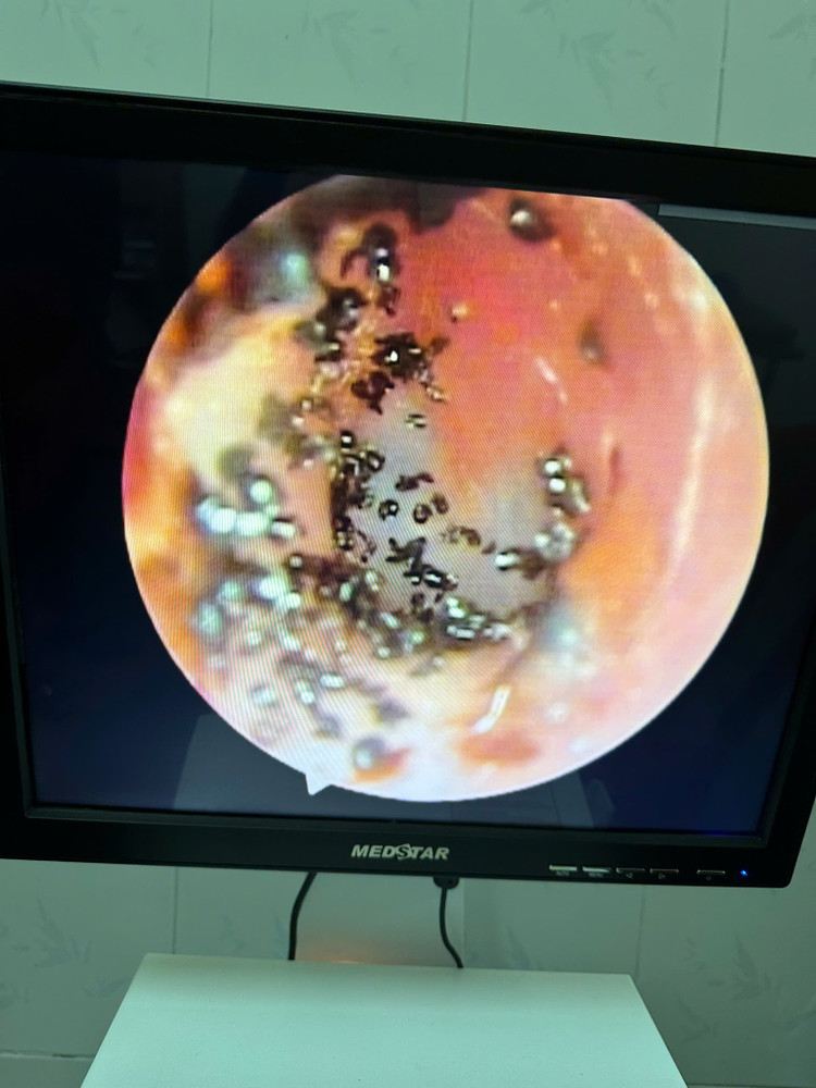 Hình ảnh nội soi cho thấy nhiều con ve chó bu bám vào tai bệnh nhi - Ảnh: TTYT huyện Đakrông.