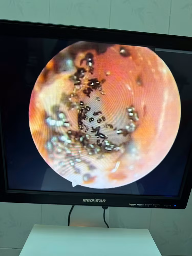 Hình ảnh nội soi cho thấy nhiều con ve chó bu bám vào tai bệnh nhi - Ảnh: TTYT huyện Đakrông.