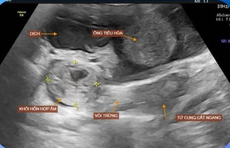 Kết quả siêu âm của bệnh nhân. Ảnh BVCC