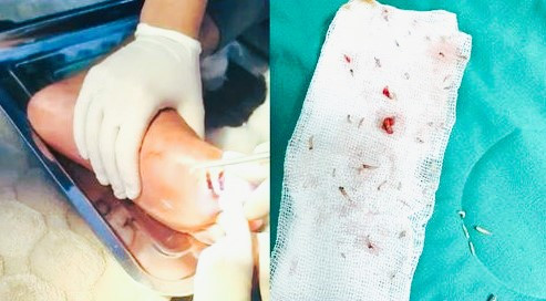 Gắp được hơn 30 con dòi trong vết thương của bệnh nhân. Ảnh TTYT huyện Thanh Ba