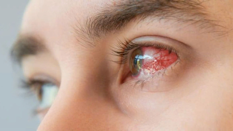 Thời gian gần đây, bệnh nhân đến khám, điều trị giang mai đang có xu hướng tăng, trong đó có người bị giảm thị lực, mù mắt. Ảnh minh hoạ/ Nguồn: Internet