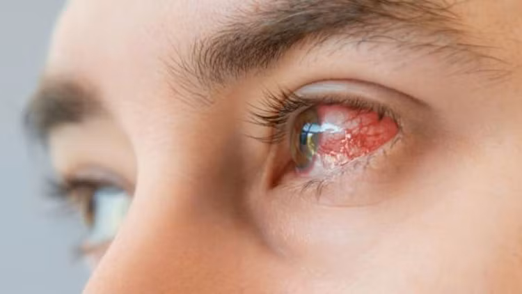 Thời gian gần đây, bệnh nhân đến khám, điều trị giang mai đang có xu hướng tăng, trong đó có người bị giảm thị lực, mù mắt. Ảnh minh hoạ/ Nguồn: Internet