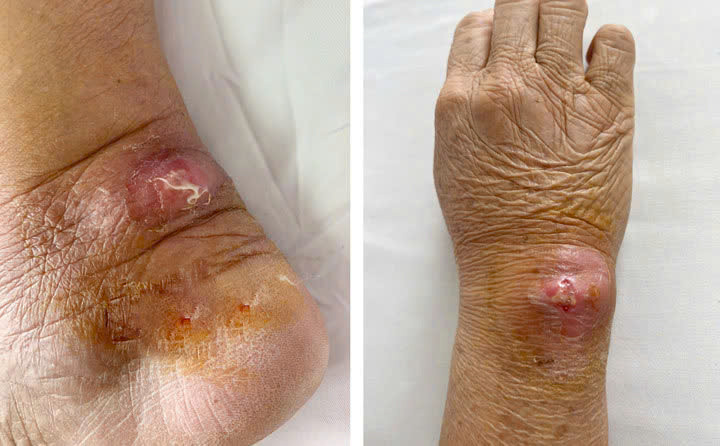 Vết thương do mèo cào của người bệnh khi nhập viện. Ảnh BVCC