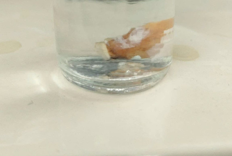 Chiếc răng giả trong phổi ông T. khi được lấy ra ngoài. Ảnh BVCC