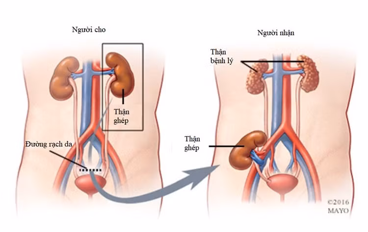 Phương pháp ghép thận cho người suy thận giai đoạn cuối