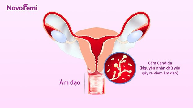 Nấm Candida là một trong những nguyên chính gây ra viêm âm đạo