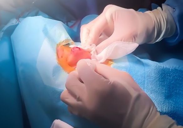 Bác sĩ đang rạch dẫn áp xe vùng mũi cho người bệnh. Ảnh BVCC