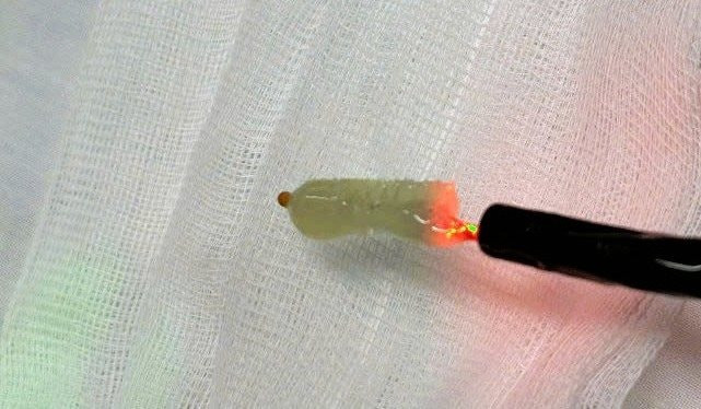 Chổi vệ sinh khí quản rơi vào đường thở được bác sĩ gắp ra ngoài. Ảnh BVCC