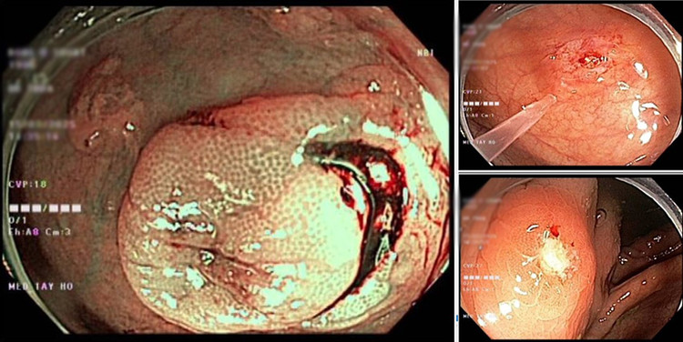Nội soi đại - trực tràng tại vị trí manh tràng, phía trên van Bauhin phát hiện ổ loét kích thước khoảng 1cm, bờ sung huyết, đáy có giả mạc, lấy bệnh phẩm làm mô bệnh học.