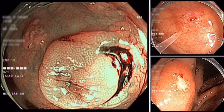 Nội soi đại - trực tràng tại vị trí manh tràng, phía trên van Bauhin phát hiện ổ loét kích thước khoảng 1cm, bờ sung huyết, đáy có giả mạc, lấy bệnh phẩm làm mô bệnh học.