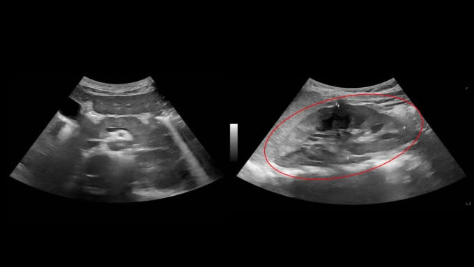 Kết quả siêu âm ổ bụng cho thấy gan bệnh nhân có dấu hiệu tổn thương, cần sinh thiết để chẩn đoán thêm. Ảnh BVCC