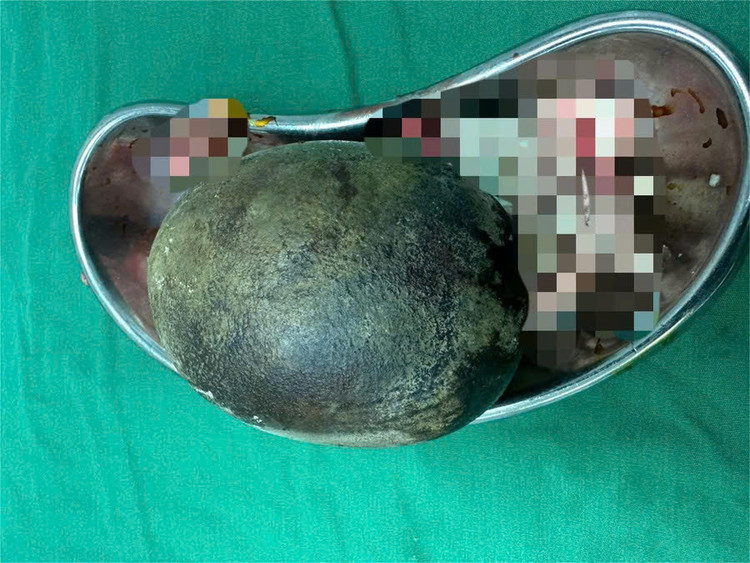 Viên sỏi bàng quang nặng 700g được lấy ra từ cơ thể bệnh nhân. Ảnh Giaoducthoidai