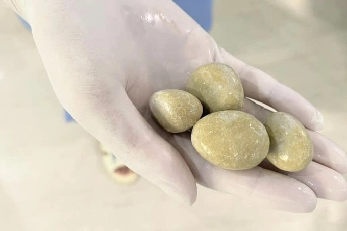 Lấy 4 viên sỏi to như &quot;quả trứng&quot; trong bàng quang người đàn ông 40 tuổi. Ảnh minh họa