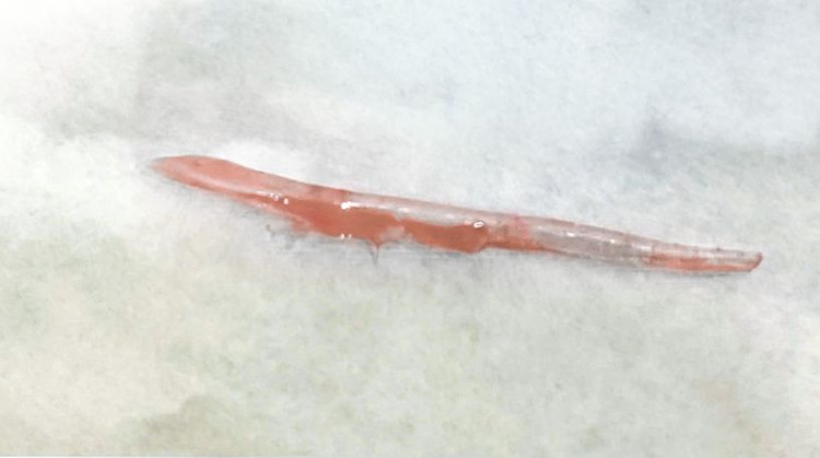 Dị vật xương cá lấy ra từ lưỡi của bệnh nhân. Ảnh BVCC Dị vật xương cá lấy ra từ lưỡi của bệnh nhân. Ảnh BVCC