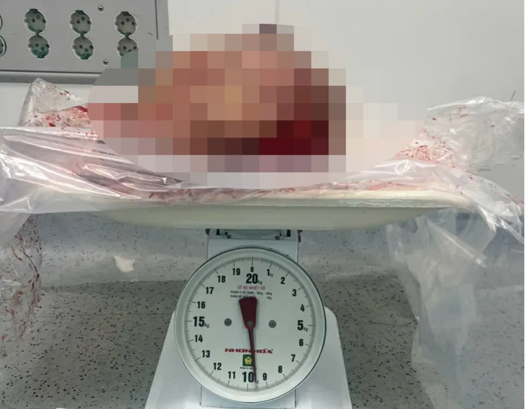 Khối u ở 1 bên vú của bệnh nhân được các bác sĩ BVĐK Đồng Nai phẫu thuật cắt bỏ. Ảnh: Báo Đồng Nai