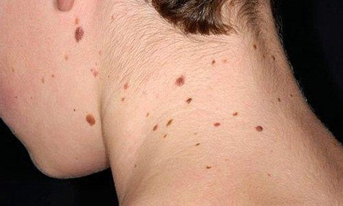 Bệnh nhân ung thư da