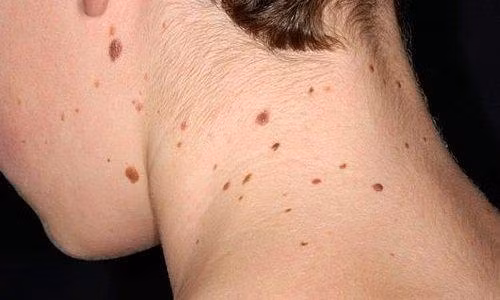 Bệnh nhân ung thư da