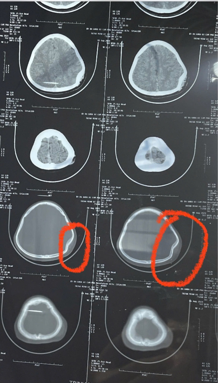 Hình ảnh CTScanner sọ não của bệnh nhân K cho thấy vỡ lún xương đỉnh trái kèm phù nề tụ khí mô mềm vị trí tổn thương. Ảnh BVCC