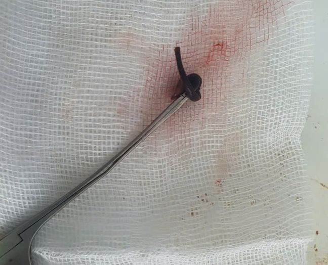 Hình ảnh con vắt sau khi được gắp ra khỏi mũi bệnh nhân. Ảnh BVCC