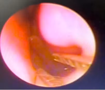 Hình ảnh Nội soi mũi bệnh nhân. Ảnh BVCC