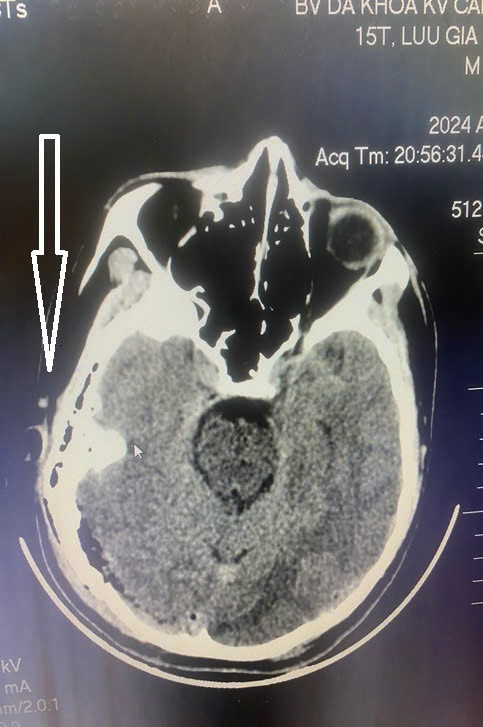 Hình ảnh CTScanner sọ não của bệnh nhân H. cho thấy có tụ máu dưới và ngoài màng cứng vùng chẩm phải, xuất huyết rãnh liên bán cầu trước , vỡ xương trán –thái dương chẩm phải vỡ xương đỉnh trái kèm tụ khí nội sọ rải rác.. ẢNh BVCC