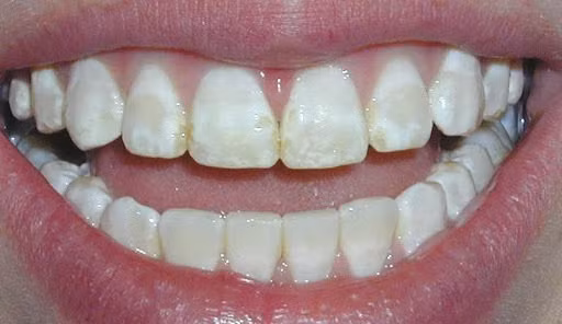 Men răng bị bào mòn. Ảnh minh họa