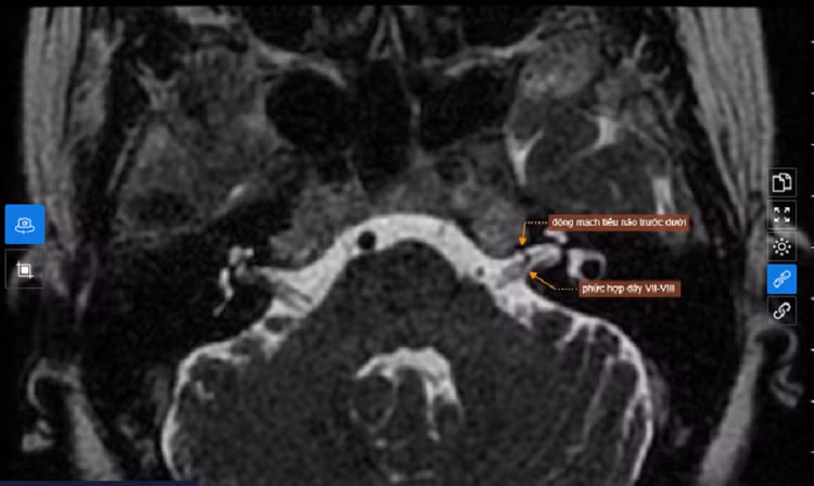 Chụp MRI sọ não cho hình ảnh thoái hóa myelin chất trắng dưới vỏ bán cầu đại não và quanh não thất bên hai bên. Bệnh BVCC