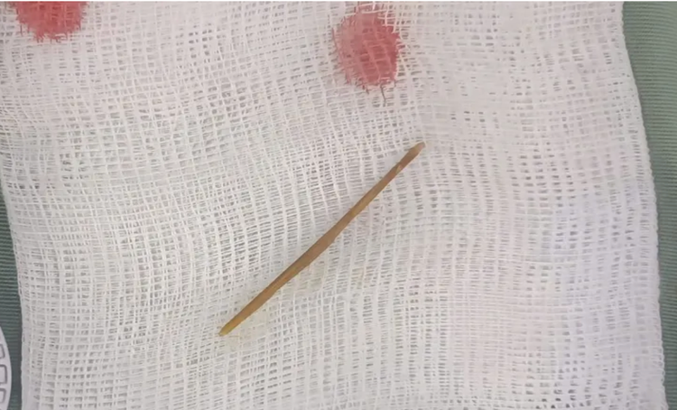 Dị vật chiếc tăm tre được lấy ra. Ảnh BVCC