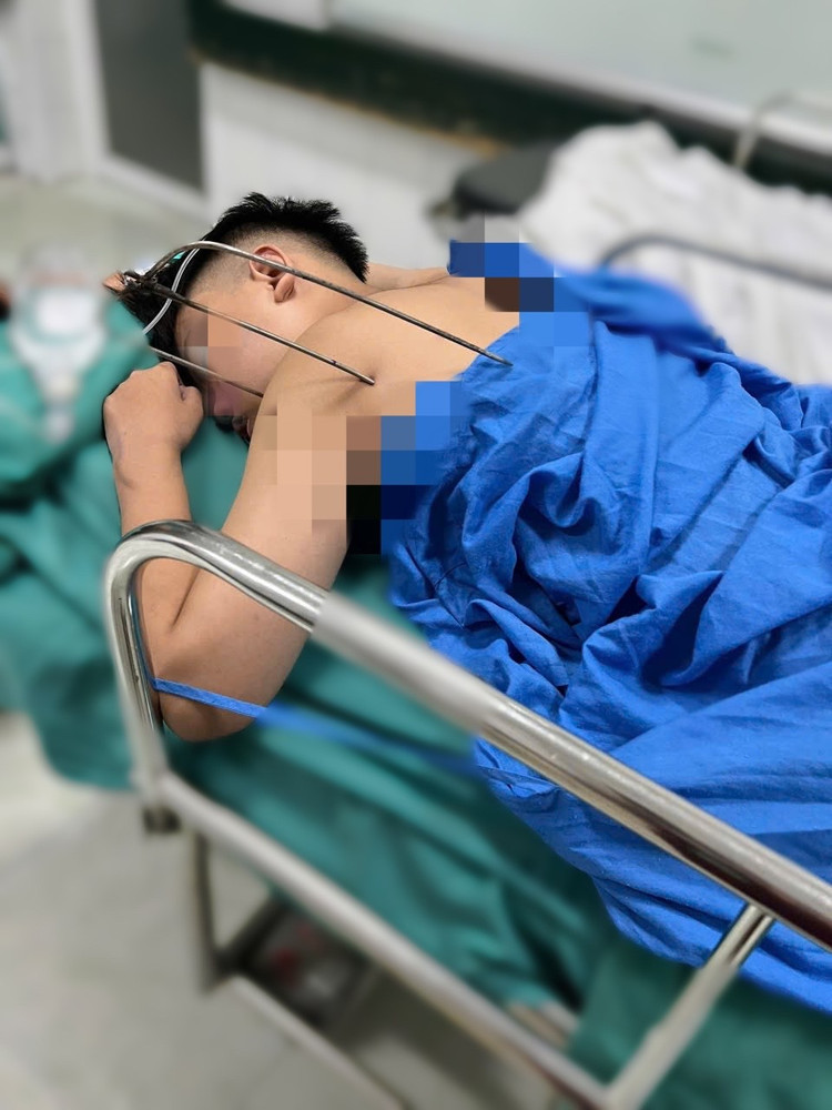 Dị vật kim loại sắc nhọn, dạng đinh ba tự chế, đâm từ phía sau vai trái, xuyên sâu vào lồng ngực, gây tổn thương phổi và tim của bệnh nhân. Ảnh BVCC