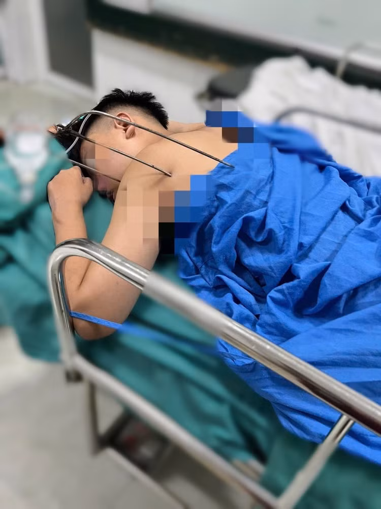 Dị vật kim loại sắc nhọn, dạng đinh ba tự chế, đâm từ phía sau vai trái, xuyên sâu vào lồng ngực, gây tổn thương phổi và tim của bệnh nhân. Ảnh BVCC