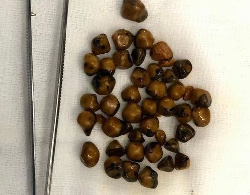 Lấy ra hơn 40 viên sỏi trong túi mật người phụ nữ 51 tuổi. Ảnh Đại nhiểu nhân dân