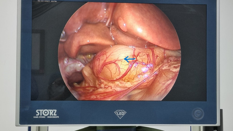 Kết quả siêu âm của bệnh nhi cho thấy hình ảnh cơ môn vị phì đại. Ảnh BVCC