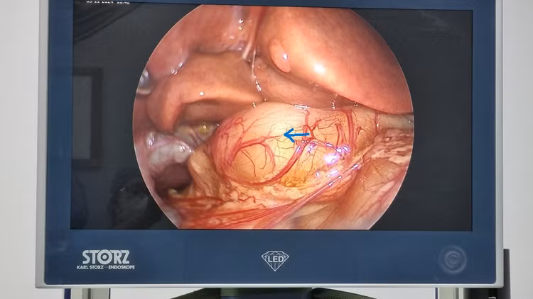 Kết quả siêu âm của bệnh nhi cho thấy hình ảnh cơ môn vị phì đại. Ảnh BVCC