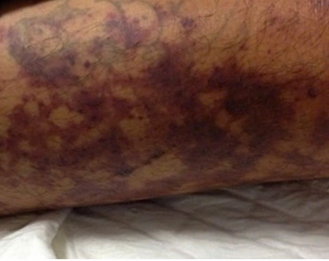 Các ban xuất huyết hoại tử trên da bệnh nhân. Ảnh: Soyte.hanoi.gov.vn Các ban xuất huyết hoại tử trên da bệnh nhân. Ảnh: Soyte.hanoi.gov.vn