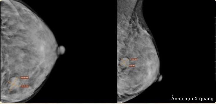 Hình ảnh chụp X-quang của bệnh nhân phát hiện khối U xơ. Ảnh BVCC Hình ảnh chụp X-quang của bệnh nhân phát hiện khối U xơ. Ảnh BVCC