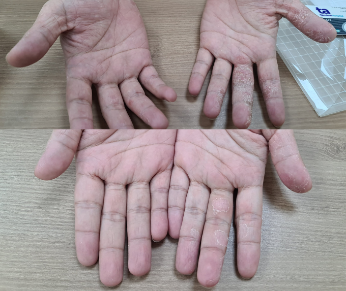 Bàn tay nhiễm nấm của một người bệnh sau một tuần điều trị nấm. Ảnh BVCC