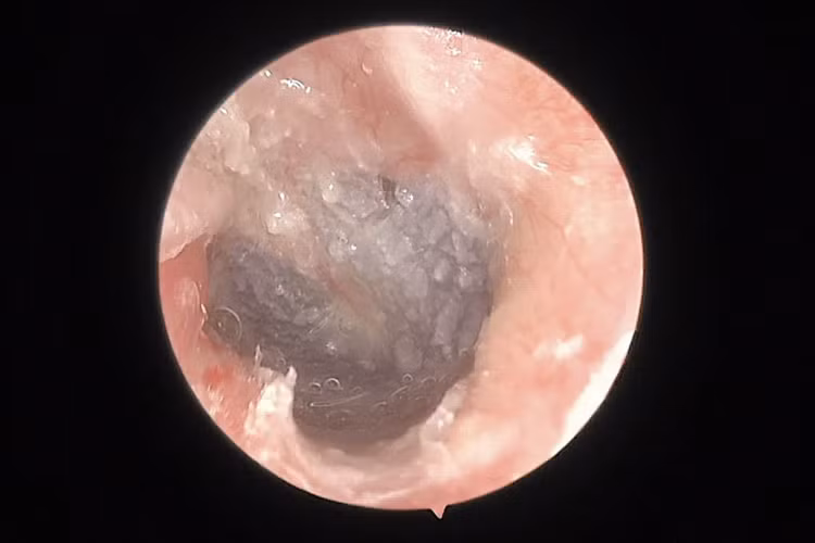 Sau 6 tháng phẫu thuật, bệnh nhân nghe tốt và không còn chít hẹp ống tai. Ảnh BVCC Sau 6 tháng phẫu thuật, bệnh nhân nghe tốt và không còn chít hẹp ống tai. Ảnh BVCC