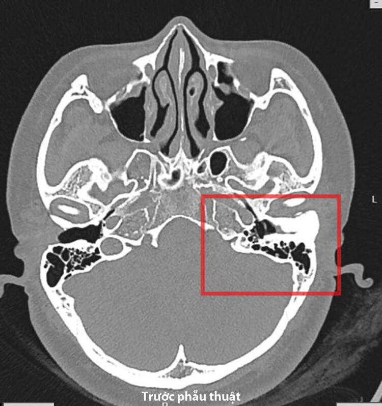 Hình ảnh khối đậm độ như xương làm chít hẹp gần như toàn bộ ống tai trái của bệnh nhân. Ảnh BVCC