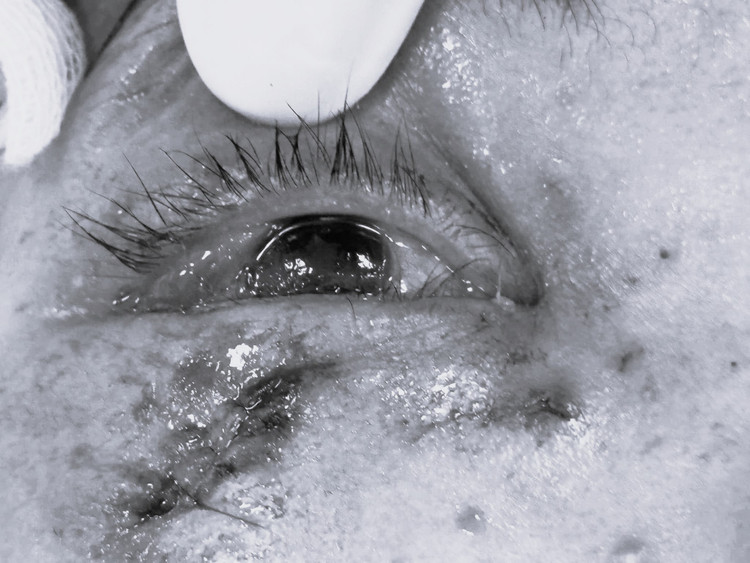 Mắt bệnh nhân bị tổn thương. Ảnh BVCC