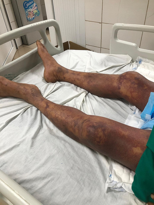 Bệnh nhân trong tình trạng xuất huyết hoại tử toàn thân. Ảnh baosuckhoevadoisong