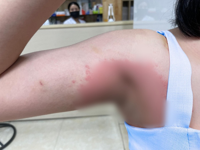 Chi hàng chục triệu làm trắng nách người phụ nữ bị dị ứng bội nhiễm. Ảnh baodanviet