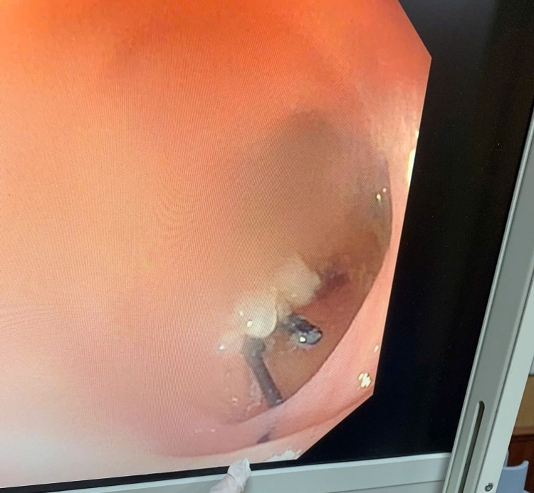 Nội soi dị vật chiếc kim băng trong dạ dày bệnh nhi. Ảnh BVCC