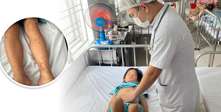 Cẩn trọng với bệnh viêm mao mạch dị ứng ở trẻ em. Ảnh BVCC