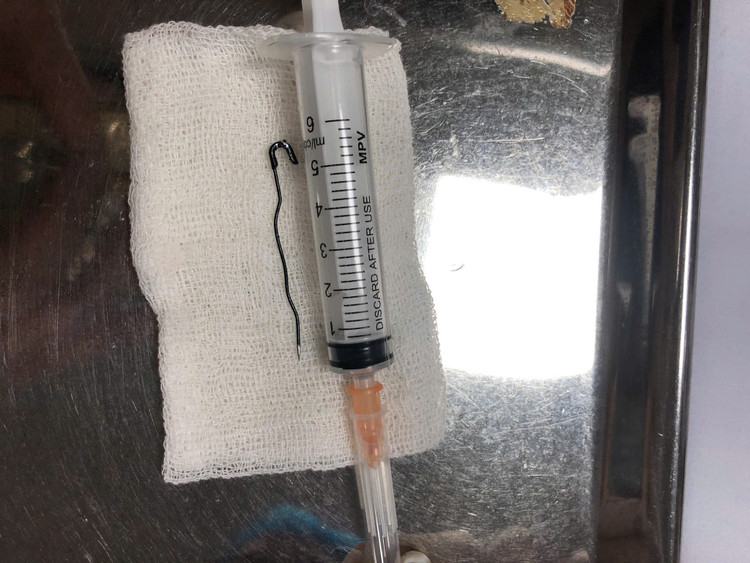Dị vật trong đường tiêu hóa của bệnh nhi. Ảnh BVCC