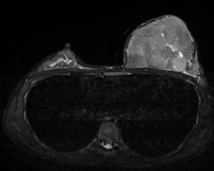 Hình ảnh MRI cho thấy vú trái phát triển kích cỡ to bất thường so với vú phải.