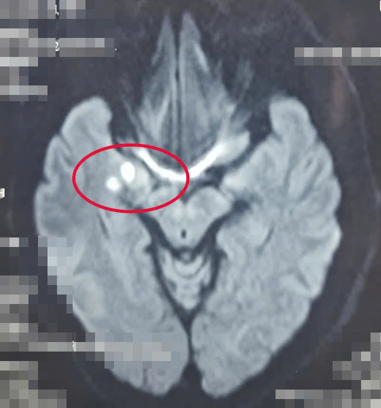 Bệnh nhân có cục máu đông gây tắc nghẽn mạch máu, dẫn đến đột quỵ Ảnh: BVCC