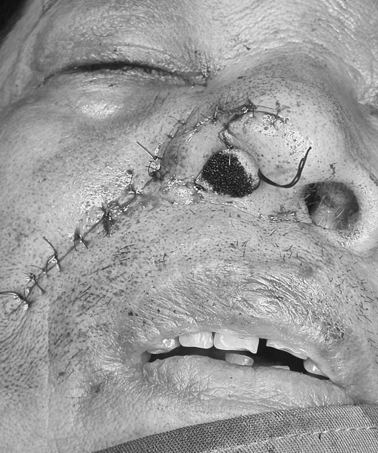 Cánh mũi phải của bệnh nhân sau ca phẫu thuật. Ảnh BVCC